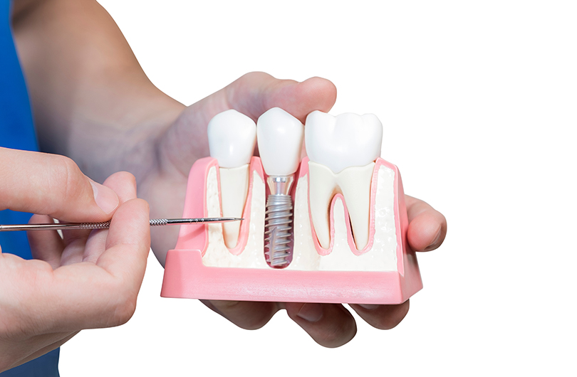 Dental implant model